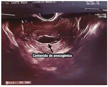 Ecografía que reporta útero en ante verso flexión con contenido anecogénico en cavidad