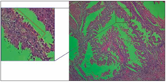 Revestimiento papilar conformado por células agrandadas o hobnail de formas poliédricas con abundante citoplasma eosinofílico con grandes núcleos hipercromáticos pleomórficos Reacción de AriasStella