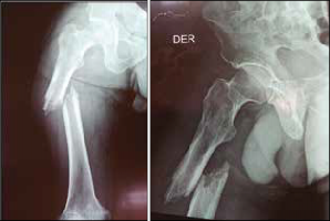 Radiografías de ingreso mostrando fractura Sub trocantérica de Fémur Derecho producto de una caída de baja intensidad diagnosticada como fractura Patológica