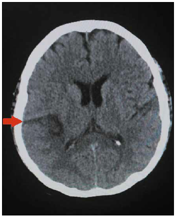 Noncontrast brain computed tomography showing an ischemic lesion hypodense area