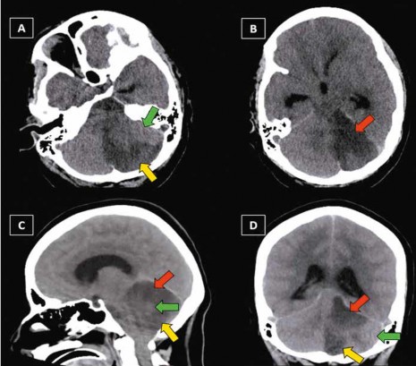 TEM de encéfalo sin contraste al ingreso hospitalario del paciente A visión axial del área de isquemia cerebelosa correspondiente a la arteria cerebelosa posteroinferior ACPI izquierda flecha amarilla y del área cerebelosa perfundida correspondiente a la arteria cerebelosa anteroinferior ACAI izquierda flecha verde B visión axial del área de isquemia cerebelosa correspondiente a la arteria cerebelosa anterosuperior ACAS izquierda flecha roja C visión sagital de las áreas correspondientes a las arterias cerebelosas izquierdas ACPI flecha amarilla ACAI flecha verde y ACAS flecha roja D visión coronal de las áreas correspondientes a las arterias cerebelosas izquierdas ACPI flecha amarilla ACAI flecha verde y ACAS flecha roja