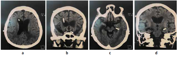 a,b. TEM cerebral presencia de SDVP en ventrículo lateral frontal así mismo disminución de edema y ausencia de tumoración c,d. TEM cerebral presencia de SDVP en ventrículo lateral izquierdo