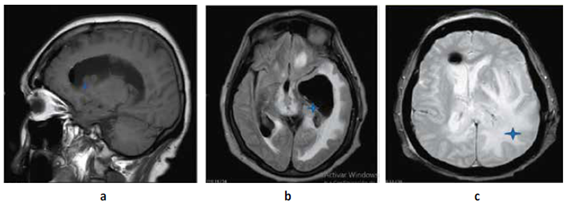 a,b. RMN Cerebral corte sagital y axial T1 donde se evidencia imágenes nodulares a isointensas que cubren el cuerpo calloso y se encuentran en ventrículos laterales en corte axial se evidencia edema transependimario y dilatación de II y III ventrículo ocasionado por tumoración ipsilateral isointensa c Flair se evidencia edema perilesional a nivel de ventrículo lateral izquierdo que ocasiona efecto de masa y desvía línea media.