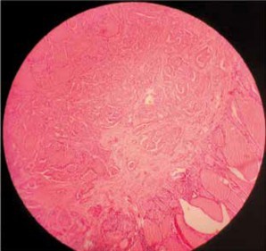 Histopatología de carcinoma medular de tiroides.