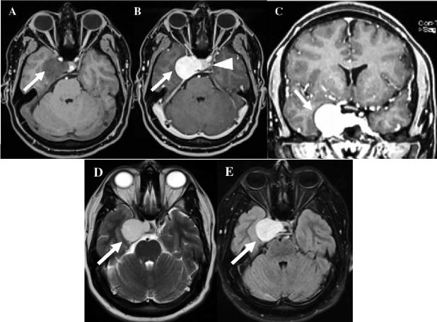 RMN cerebral. A. Corte axial en secuencia T1 donde se evidencia proceso expansivo hipointenso en el seno cavernoso derecho (flecha). B. Corte axial en secuencia T1 contrastada que evidencia que el proceso expansivo capta ávidamente contraste (flecha) e invade la silla turca desplazando la hipófisis hacia la izquierda (cabeza de flecha). C. Corte coronal en secuencia T1 contrastada que evidencia el proceso expansivo hipercaptador de contraste (flecha). D. Corte axial en secuencia T2 que evidencia que el proceso expansivo del seno cavernoso es altamente hiperintenso (flecha). E. Corte axial en secuencia FLAIR que evidencia el proceso expansivo hiperintenso (flecha).